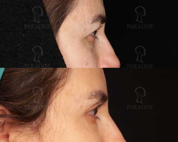 عکس بلفاروپلاستی دکتر هومن گنجه خسروی