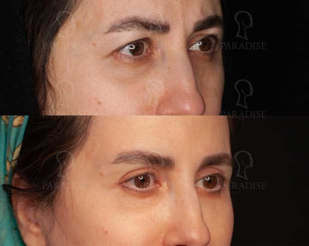 عکس بلفاروپلاستی دکتر هومن گنجه خسروی