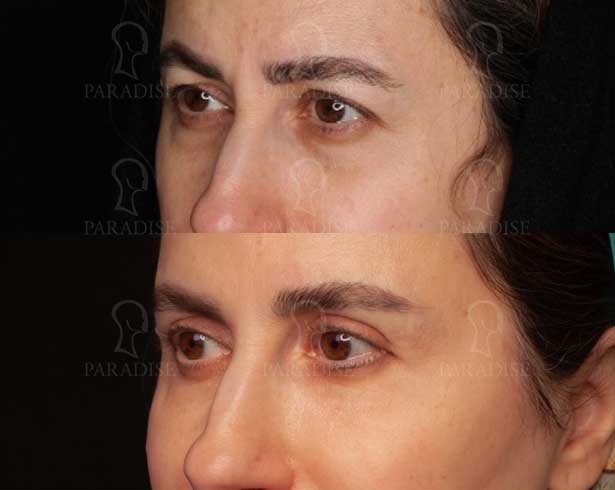 عکس بلفاروپلاستی دکتر هومن گنجه خسروی