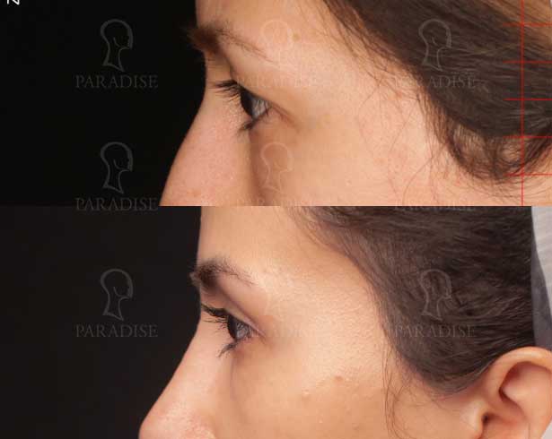 عکس بلفاروپلاستی دکتر هومن گنجه خسروی