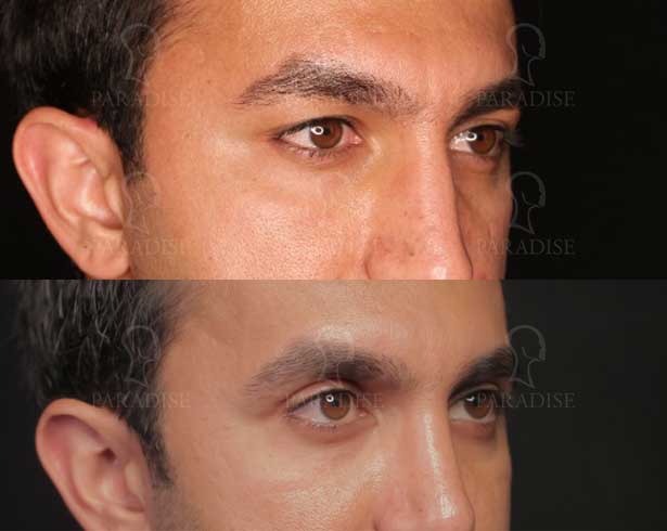 عکس بلفاروپلاستی دکتر هومن گنجه خسروی