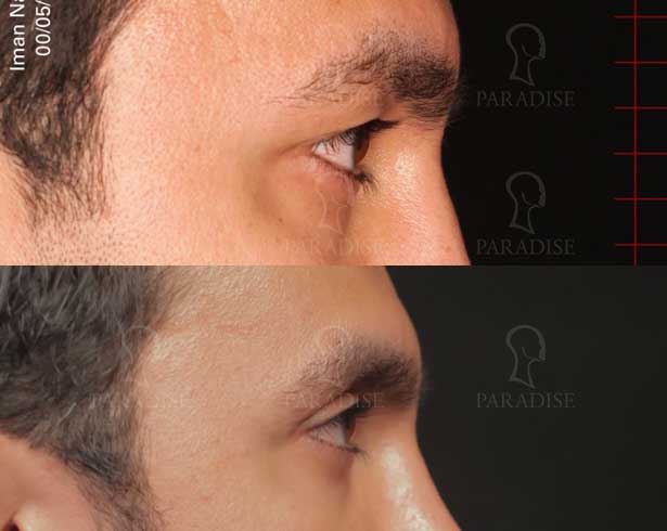 عکس بلفاروپلاستی دکتر هومن گنجه خسروی