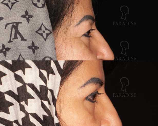 عکس بلفاروپلاستی دکتر هومن گنجه خسروی