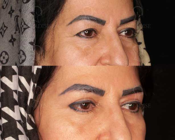 عکس بلفاروپلاستی دکتر هومن گنجه خسروی