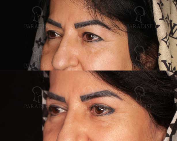 عکس بلفاروپلاستی دکتر هومن گنجه خسروی