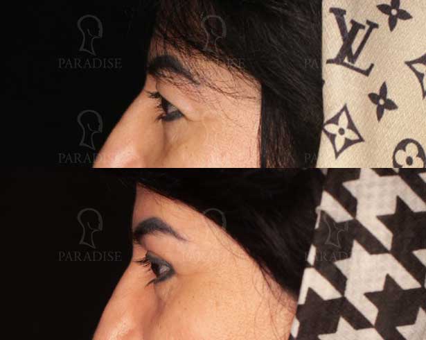 عکس بلفاروپلاستی دکتر هومن گنجه خسروی