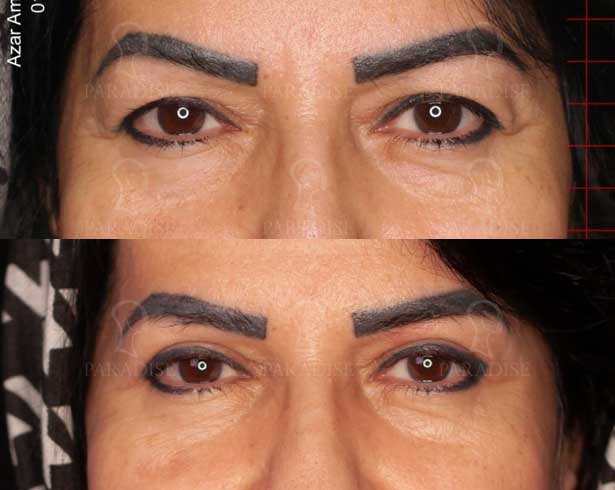 عکس بلفاروپلاستی دکتر هومن گنجه خسروی