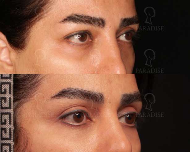 عکس بلفاروپلاستی دکتر هومن گنجه خسروی