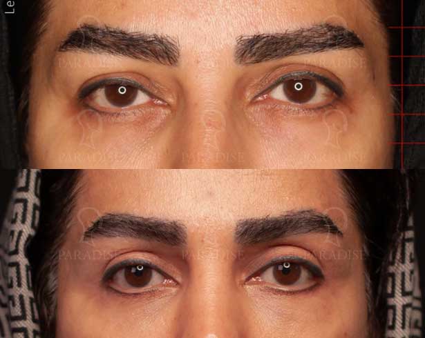 عکس بلفاروپلاستی دکتر هومن گنجه خسروی