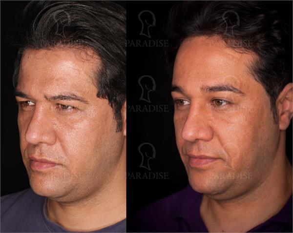 عکس از بلفارو پلاستی عمل زیبایی پلک