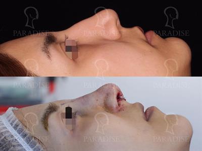 عکس-قبل-از-عمل-تیپ-پلاستی-دکتر-گنجه-خسروی 21