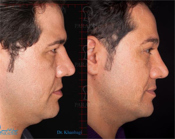 عکس از بلفارو پلاستی عمل زیبایی پلک