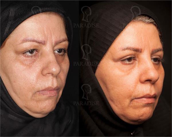 عکس از بلفارو پلاستی عمل زیبایی پلک