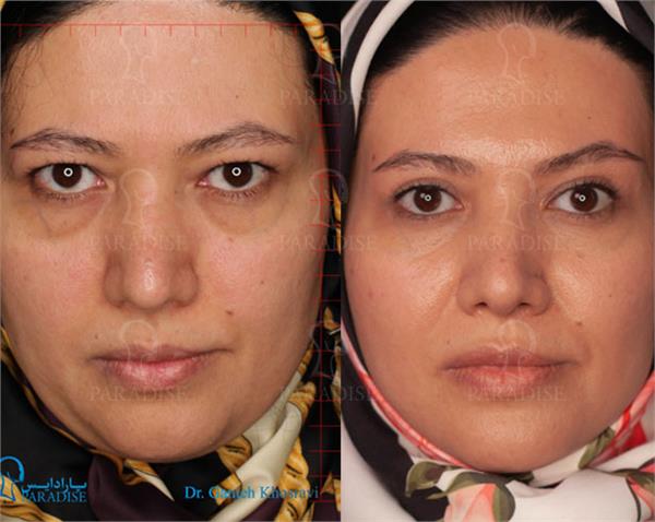 عکس از بلفارو پلاستی عمل زیبایی پلک