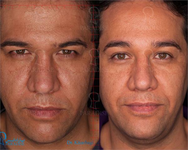 عکس از بلفارو پلاستی عمل زیبایی پلک