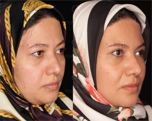 عکس از بلفارو پلاستی عمل زیبایی پلک