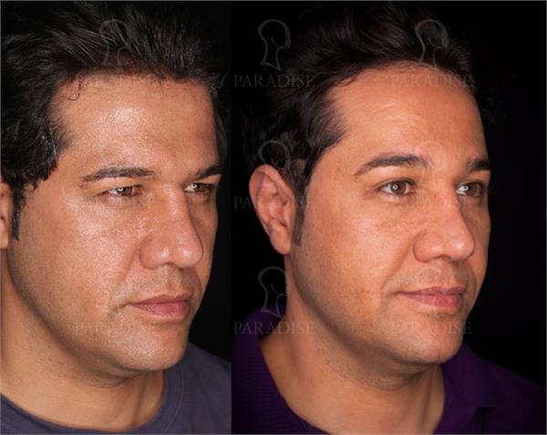 عکس از بلفارو پلاستی عمل زیبایی پلک