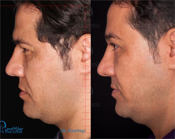 عکس از بلفارو پلاستی عمل زیبایی پلک