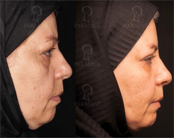 عکس از بلفارو پلاستی عمل زیبایی پلک